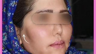 هزینه تزریق چربی در سال چقدر است؟