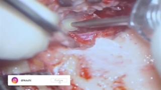 عمل جراحی کلستئاتوم کانال گوش خارجی