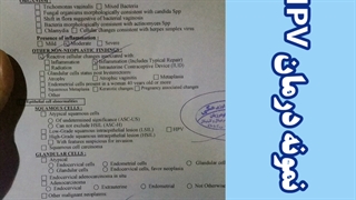 درمان زگیل تناسلی