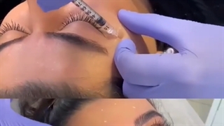 بوتاکس چشم گربه ای