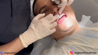 لمینت دندان در کلینیک  دهان پزشکی و دندانپزشکی نگین شیراز