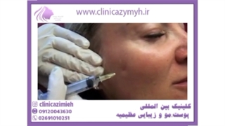 مزوتراپی صورت توسط دکتر علیزاده لیزر فرکشنال