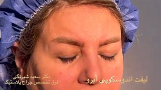 فیلم واقعی بلافاصله لیفت اندوسکوپی ابرو