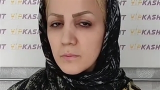 قبل و بعد از پیوند ابرو- کلینیک vip تهران