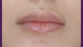 مراقبت های بعد از تزریق ژل لب