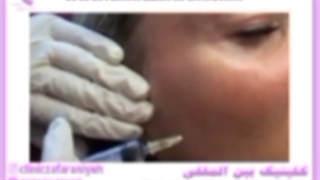 مزوتراپی صورت توسط دکتر علیزاده