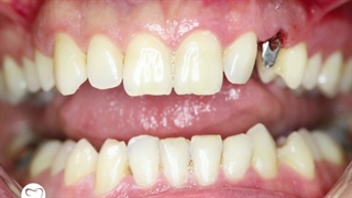 یک واحد ایمپلنت