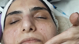 سرم تراپی یکی از مراحل عالی اثرگذاری فیشیال پروتز سینه