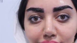 کاشت ابرو