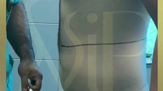 هزینه عمل لیپوماتیک در بهترین مرکز تهران