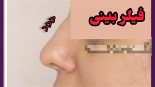 تزریق ژل دائمی به بینی