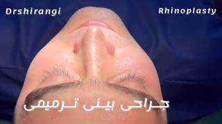 جراحی ترمیمی بینی - عمل بینی ثانویه در کلینیک تهران