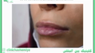 تزریق ژل لب با کائوال
