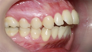 ارتوسرجری عقب بودن فک پایین | دکتر داودیان