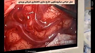 عمل جراحی میکروسکوپی خارج سازی ناهنجاری شریانی وریدی