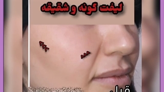 آیا نخ ها در صورت قابل مشاهده هستند؟