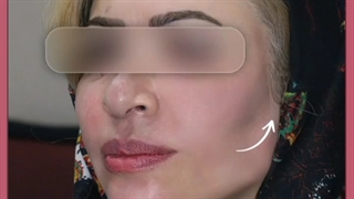 هزینه و قیمت تزریق چربی چقدر است؟