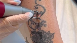 فیلم پاک کردن تتو (کلینیک زیبایی استاربیوتی )