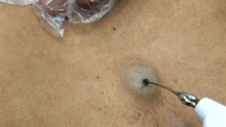 غده چرکى (لیپوم)