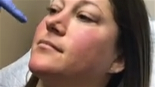 تزریق بوتاکس چشم گربه ای چگونه هست