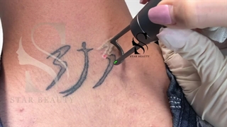 سریعترین روش پاک کردن تتو (کلینیک زیبایی استاربیوتی)