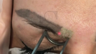 عالی ترین روش پاک کردن ابرو (کلینیک زیبایی استار بیوتی )