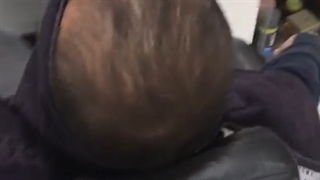 رفع کچلی مو  در چند ثانیه