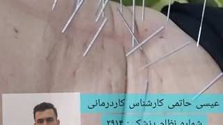 نوروآکوپانکچر( طب سوزنی یا سوزن خشک) مشهد