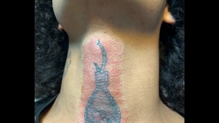 پاک کردن سریع تتو (کلینیک استار بیوتی )