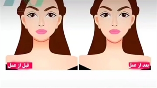 مزایای پروتز چانه