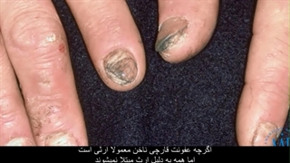 پیشگیری و درمان قارچ ناخن