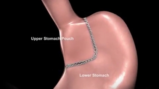 عمل بای پس معده، از انواع جراحی برای لاغری به روش لاپاراسکوپی