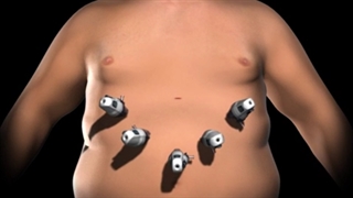 عمل بای پس معده، از انواع جراحی برای لاغری به روش لاپاراسکوپی