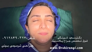 نتیجه جراحی بینی استخوانی در بهترین کلینیک تهران