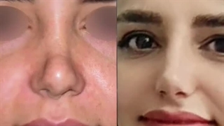 جراحی زیبایی ترمیمی بینی
