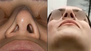جراحی زیبایی ترمیمی بینی