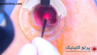 فیلم عمل هموروئید داخلی با-لیزر