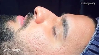 جراحی بینی (رینوپلاستی) برای مردان در تهران
