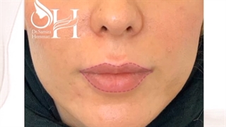 فرم دهی و لیفت لب به روش روسی