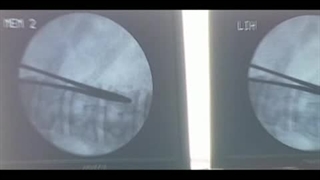 ویدیو طریقه درمان دیسک کمر با لیزر توسط پروفسور مومن زاده