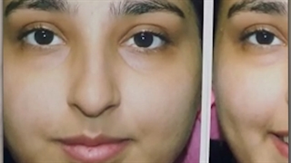 جراحی بینی استخوانی با افتادگی نوک بینی