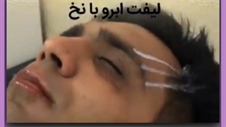 لیفت ابرو
