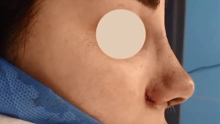 عمل بینی نیمه فانتزی