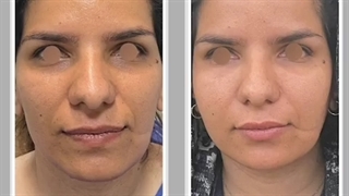 جوانسازی پوست