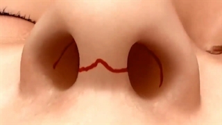 بارداری بعد از جراحی بینی
