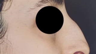 فیلم جراحی بینی با قوز و انحراف شدید