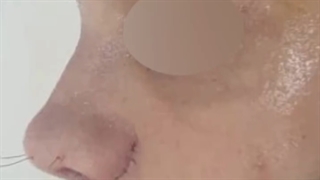 فیلم جراحی بینی گوشتی در اتاق عمل