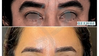 فیلم واقعی جراحی بلفاروپلاستی