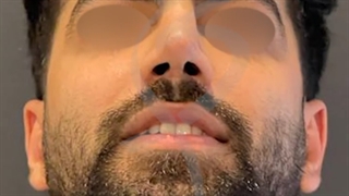 نتیجه بعد از عمل جراحی بینی مردانه