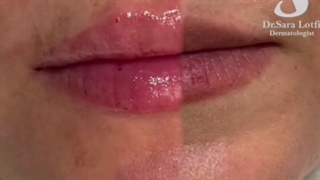 یک سی سی جوانسازی